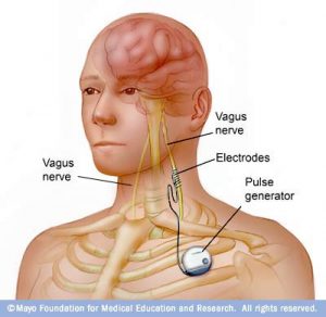 medical stimulation of vagus nerve